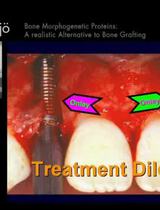 Bone Morphogenetic Proteins, A Realistic Alternative to Bone Grafting