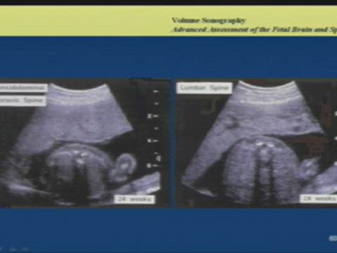 3D-4D Fundamentals for OB/GYN Sonography Part 3