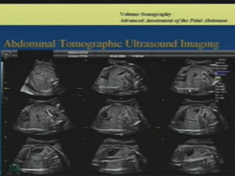 3D-4D Fundamentals for OB/GYN Sonography Part 5