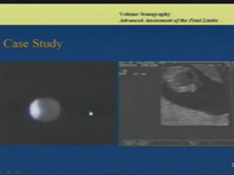 3D-4D Fundamentals for OB/GYN Sonography Part 7